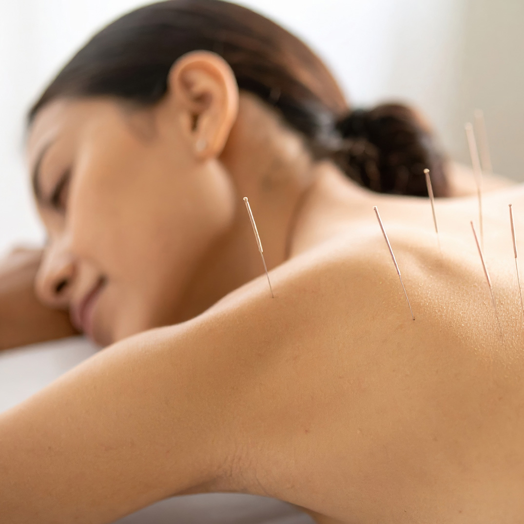 acupuncture