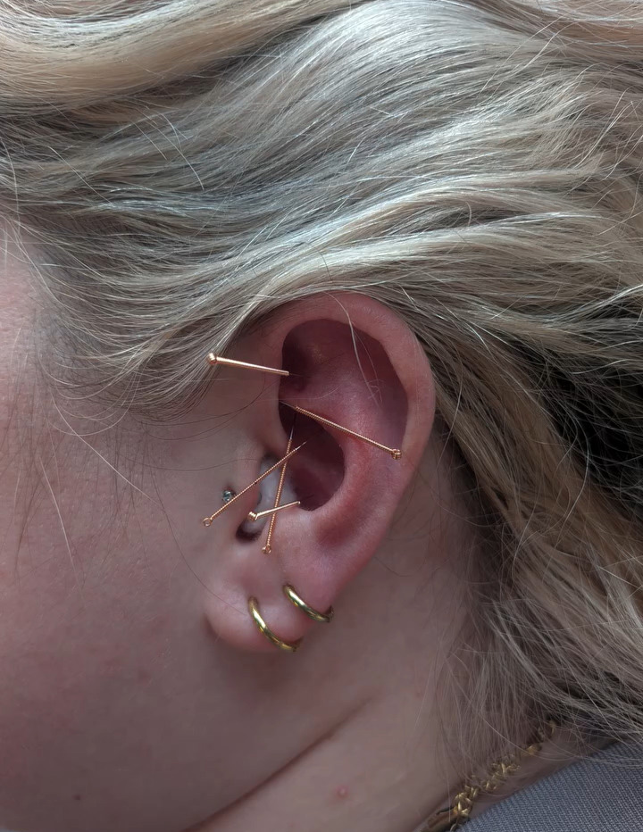 auricular acupuncture
